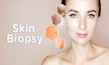 Skin-Biopsy-Thumbnail
